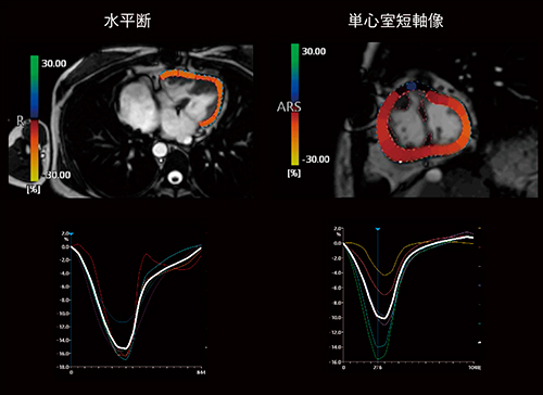 図1　フォンタン術後単心室の解析例（ストレイン） 単心室のように正常解剖と異なる心臓においても、精度の良いトラッキングが可能となっている。