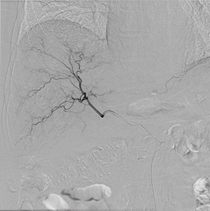 DSA画像：TACEにおける血管造影にて、肝内の細かな末梢血管まで描出が可能