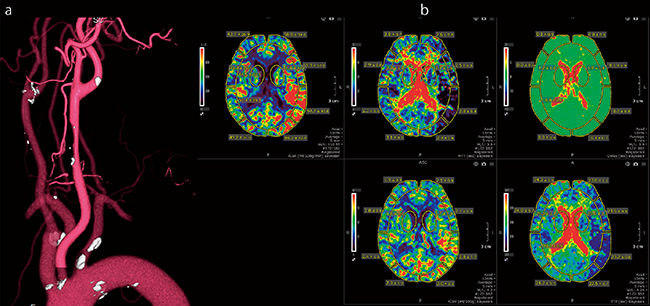 総頸動脈の狭窄所見と頭蓋内灌流異常を1回の検査で検出 a：頸部3D-CTA　b：perfusion map（上段左からCBF、MTT、Delay、下段左からCBV、TTP）