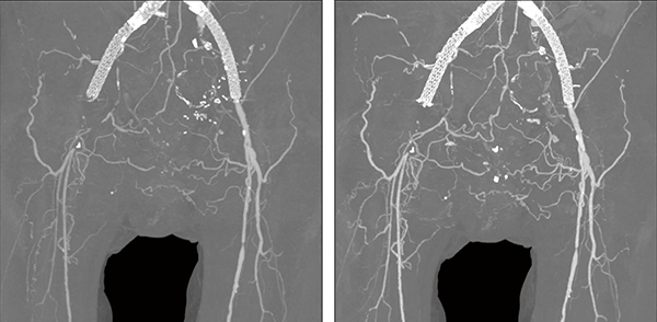 図2　下肢動脈造影 CTDIvol＝3.6mGy、DLP＝423.1mGy・cm AiCE-i再構成により、低被ばくで、かつ末梢の血管まで描出能が向上している。