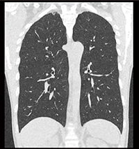 図3　検診正常例（AiCE-iによる超低線量スクリーニング） CTDIvol：0.2mGy、DLP：8.3mGy・cm ディープラーニング再構成が搭載されたことで、従来16列CTのルーチン胸部CTでの平均CTDIvol：12mGyと比較して、1/60程度の線量で撮影できている。肺尖部・肺底部の構造も明瞭に観察可能。