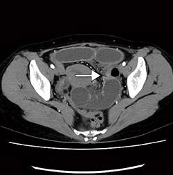 図4　子宮広間膜ヘルニア beak signや腸間膜脂肪濃度混濁が従来画像と比べ明瞭に描出されており、この情報を基にターゲットを絞った腹腔鏡下手術が可能であった。