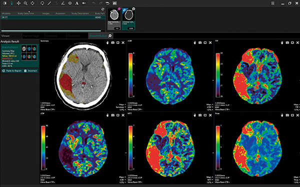図2　Brain Perfusion（脳灌流解析）アプリケーションの解析結果
