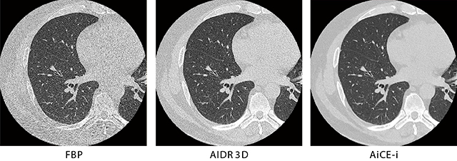 図1　HRCTの画像比較（50mAs） 50mAsの低線量撮影でも、AiCE-iを用いることで劇的にノイズが低減した。放射線科読影医からも線量を下げて撮影しても問題ないと評価が得られており、肺がん検診などのプロトコールへの適用を検討中。