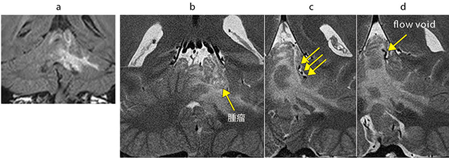 図2　高分解能MRIによる小脳血管芽腫 FLAIR画像では左小脳に浮腫が広がっているが病変は同定できない（a）。高分解能T2強調画像では、浮腫内部に境界明瞭で内部に小囊胞構造を複数伴う腫瘤を認める（b）。腫瘤から連続するflow voidも明瞭に確認でき血管芽腫が疑われた（c、d）。