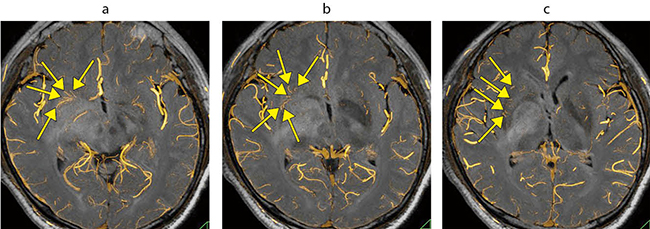 図3　右基底核低悪性度神経膠腫の高分解能CTAとFLAIRのフュージョン画像 右基底核のT2延長病巣とLSA（↑）との位置関係を明瞭に同定できる。