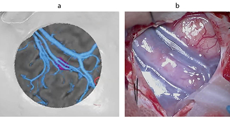 図4　右シルビウス裂近傍の播種性髄芽腫生検における脳表の静脈の描出 術野をイメージした3D再構成画像（a）は、小開頭後の脳表の術中写真（b）と近似している。