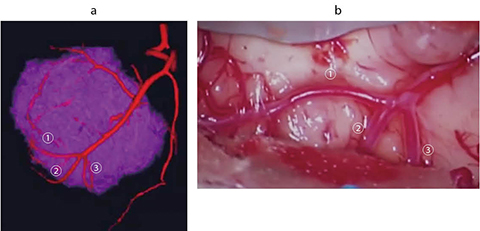 図5　左前頭葉膠芽腫術前の腫瘍周囲の血管の描出 a：術野における腫瘍と高分解能CTAによる動脈のフュージョン画像では、動脈が腫瘍後方で三つ叉に分岐していることが確認できる。 b：腫瘍摘出中の術中写真で腫瘍後方の動脈の三つ叉が確認できる