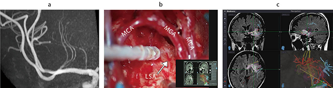 図6　右島を中心とした乏突起膠腫での高分解能MRAによる穿通枝の描出 a：高分解能MRAにより、LSAが末梢まで描出されている。 b：術中写真。中大脳動脈（MCA）の間から腫瘍を摘出していくと最深部にLSAが出現する。 c：高分解能MRA画像を融合した術中ナビゲーション画像。腫瘍深部のLSAに到達していることが確認できる。