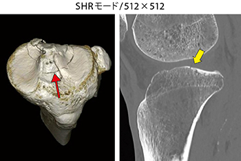 図3　脛骨近位端骨折（40歳代、男性）