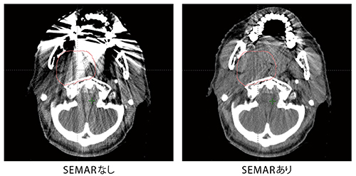 症例1　中咽頭がん SEMARを用いることで金属アーチファクトが低減され、腫瘍の輪郭描出 （コンツーリング）がより正確になる。