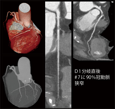 症例1　冠動脈CT 糖尿病、高血圧、脂質異常症で通院中の患者が、最近息切れが生じ心臓超音波検査、冠動脈CT検査を行った。CTで冠動脈の高度狭窄を確認し、迅速に冠動脈造影検査、経皮的冠動脈形成術（PCI）を行えた。