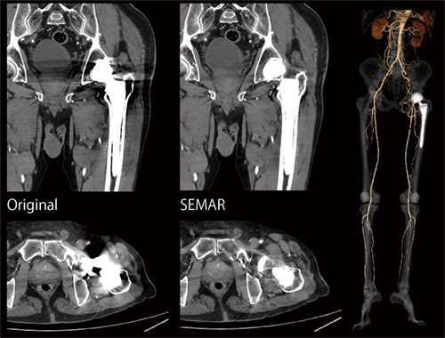 症例2　下肢動脈造影（SEMAR適用） 腎機能低下（eGFR 40mL/min/1.73m2）のため、造影剤低減プロトコール（2割低減）にて撮影。人工股関節による金属アーチファクトをSEMARにて効果的に低減。