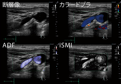 図2　頸動脈狭窄例のiSMI画像（右下）