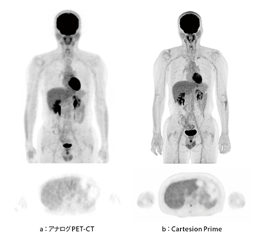 図1　全身PET-CT画像（健常ボランティア） 半導体検出器を搭載したCartesion Prime（b）はTOF時間分解能が高く、見た目の分解と感度が向上し、アナログPET-CT（a）に比べて精細かつ均一性の高い画像が得られている。