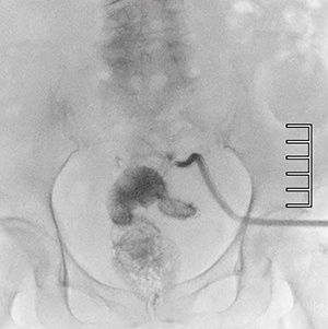 症例3　直腸穿孔に伴う膿瘍腔内のドレナージ造影 線量モードをMidにて実施。Normalに比しSN低下は顕著であるが，外径6mmのドレーンとX線不透過ライン，また造影剤の視認性は確保できている。