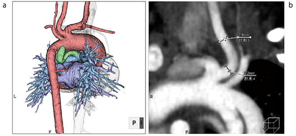 図2　小児心臓CT心電図同期検査 a：息止め指示なしにて1beat撮影　b：呼吸や心拍の影響がなく正しく、血管計測が可能