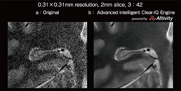 図2　3T MRIでの海馬の画像