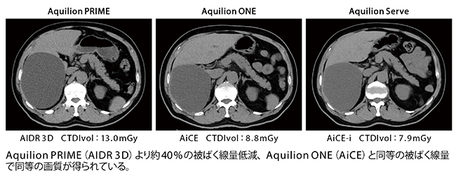 Aquilion Serveによる臨床画像（同一患者）