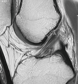 図1　左膝MRIプロトン密度矢状断像 前十字靭帯の前内側線維束（A）と後外側線維束（P）が明瞭に判別できる