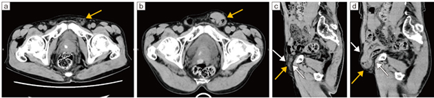 70歳代、男性、鼠径ヘルニアの症例 同日に施行した通常の臥位CT横断像（a）、立位CT横断像（b）、通常の臥位CT矢状断像（c）、立位CT矢状断像（d）を示す。 通常の臥位CT（a、c）では、左鼠径ヘルニアは指摘困難である（←）。またヘルニア門も小さい（c↓）。一方、立位CT（b、d）では、臥位に比べてヘルニア門が大きくなり（d↓）、左鼠径ヘルニアがあって小腸が脱出していることが診断可能となる（←）。この患者は、日常生活、特に立位での左下腹部不快感・左下腹部痛を訴えていたが、通常の臥位CT（a、c）では有症状の状態をとらえられずに診断が困難であることに注意が必要である。