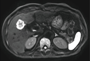 図1　転移性肝腫瘍（呼吸同期併用DWI）