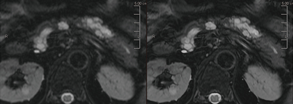 図2　IPMN（脂肪抑制T2WI　左：従来型再構成、右：PIQE再構成）