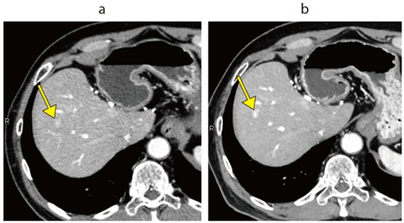 図1　肝細胞がん a：Aquilion PRIME（AIDR 3D＊） b：Aquilion ONE / INSIGHT Edition（PIQE）