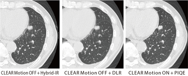 図2　原発性肺がん、肺転移症例で経過観察中 PIQE+ CLEAR Motionの併用で、心拍動に伴うアーチファクトを低減し、高い時間分解能かつ高精細画像の両立が期待できる。