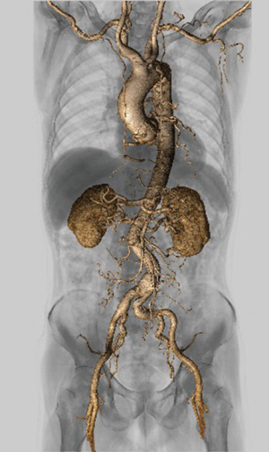 図3　大動脈解離 高速ヘリカルスキャンとAbierto Visionで全身血管を描出