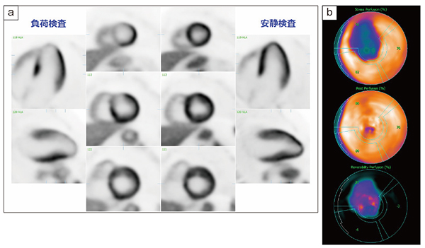 図1　心臓アンモニアPET a：負荷時、安静時の血流評価　b：Bull’s eye（上段：負荷、中段：安静）