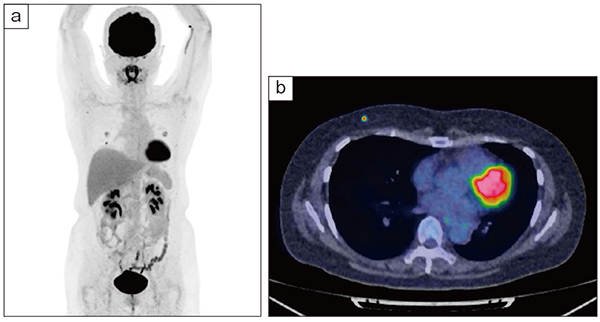 図2　FDG-PET a：MIP画像 b：fusion（axial）画像