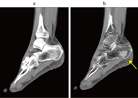 図1　踵骨 Dual Energy撮影 a：骨条件　b：VNCa VNCa画像では骨折（↑）が確認できる。