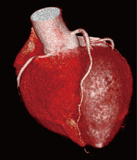 図3　冠動脈撮影　100kVによるFlash撮影