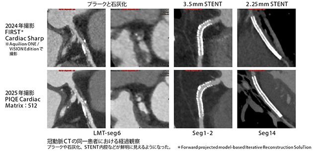 Aquilion ONE / INSIGHT Editionによる臨床画像