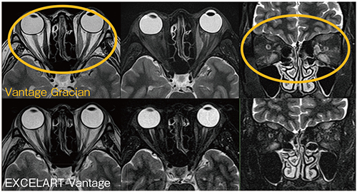 図2　甲状腺眼症の眼窩部MRI