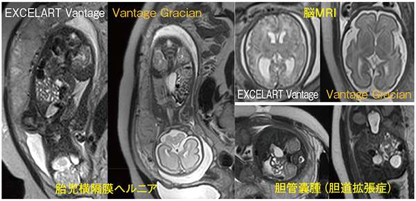 図4　胎児MRI：Severe conditionでより威力を発揮