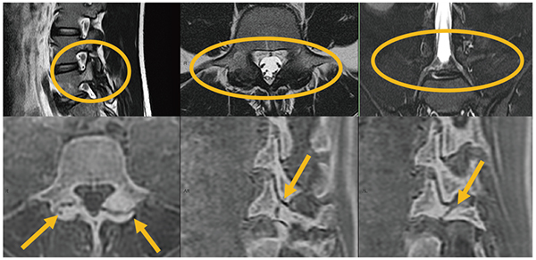 図5　追加シーケンスによる診断能向上（下段：bone weighted image）
