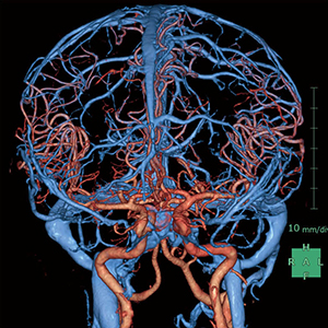 図1　脳動脈瘤の頭部CTA（3D画像）