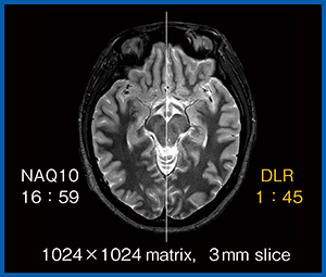 図2　高分解能PD STIR画像における10回加算とDLRの比較