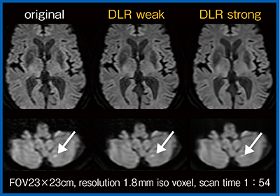 図3　1.8mm iso voxel高分解能whole brain DWIにおけるDLRの効果