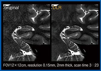 図6　海馬の高分解能2D-T2強調画像におけるノイズ低減