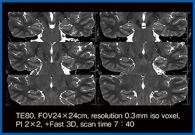 図7　0.3mm iso voxel 3D-T2強調画像におけるフローアーチファクトの低減