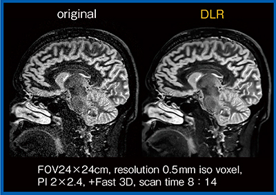 図8　MS症例の1.4mm iso voxel 3D-DIR画像におけるDLRの効果