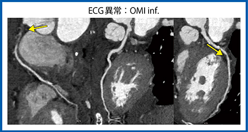 図6　症例5：心電図異常，陳旧性心筋梗塞疑い，心臓CT
