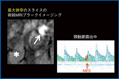 図1　右頸部内頸動脈狭窄症（72歳，男性）の術前プラークイメージング