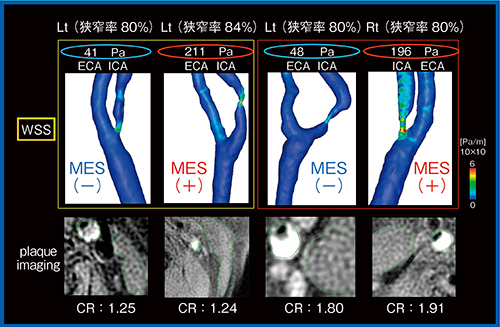図6　MRIの頸動脈プラークイメージングとCFD解析でのWSSの比較
