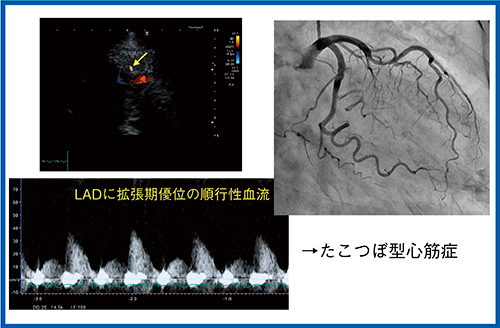 図4　症例2のLADの冠動脈血流予備能