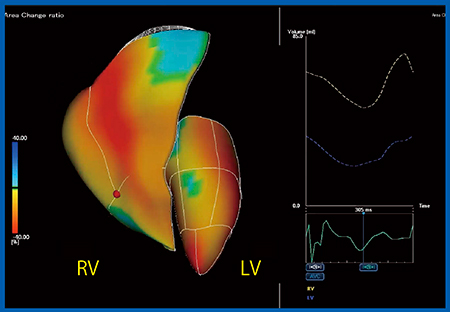 図4　Quad Chamber Tracking：総動脈幹症に対するRestelli術後の右室と左室