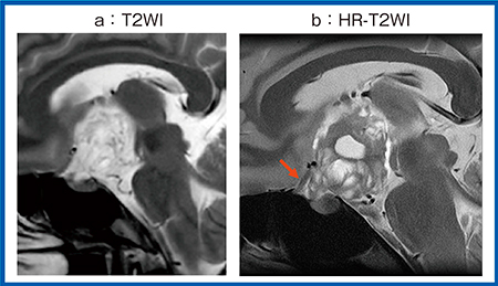 図1　症例1：頭蓋咽頭腫におけるHR-T2WIの有用性